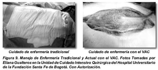 Manejo de Enfermería Tradicional y Actual con el VAC Manejo de Enfermería Tradicional y Actual con el VAC