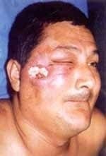 Úlcera malar con piel violácea