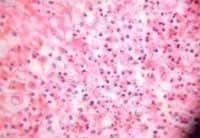 Muestra necrosis colicuativa