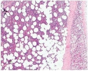 Mielolipoma subyacente al tejido cortical