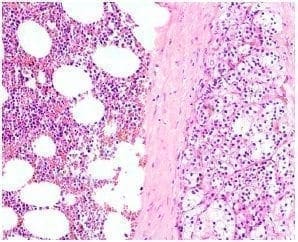 El mielolipoma suprarrenal
