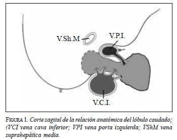 Corte Sagital de la Relación Anatómica del Lóbulo Caudado