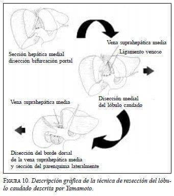 Técnica de Resección del Lóbulo Caudado descrita por Yamamoto Técnica de Resección del Lóbulo Caudado descrita por Yamamoto