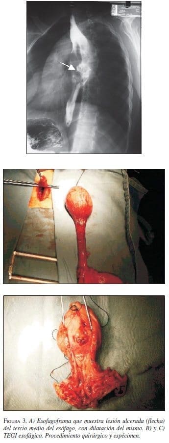 Esofagoframa que Muestra Lesión Ulcerada Esofagoframa que Muestra Lesión Ulcerada