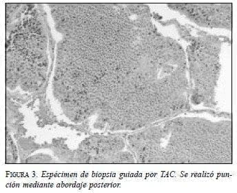 Espécimen de Biopsia guiada por TAC