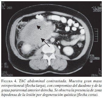 TAC abdominal contrastada, masa retroperitoneal TAC abdominal contrastada, masa retroperitoneal