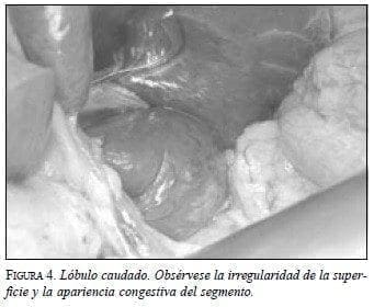 Lóbulo Caudado, Superficie y Apariencia Congestiva del Segmento