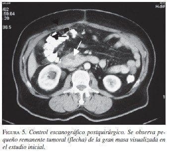 Control Escanográfico Postquirúrgico Control Escanográfico Postquirúrgico