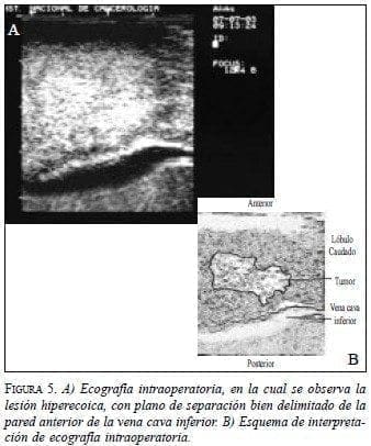 Lóbulo Caudado, Lesión Hiperecoica