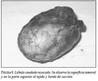 Lóbulo Caudado Resecado