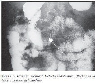 Tránsito Intestinal Tránsito Intestinal