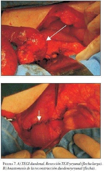 TEGI Duodenal TEGI Duodenal