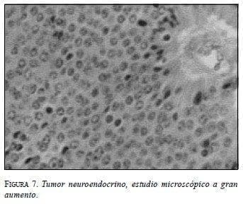 Tumor Neuroendocrino