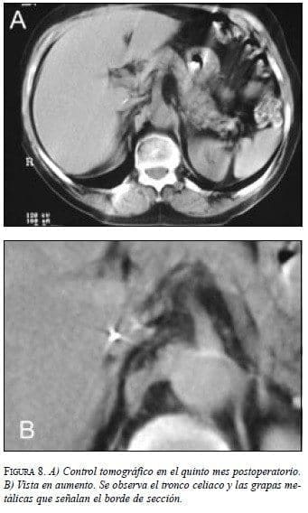 Lóbulo Caudado, Tronco Celiaco y las Grapas Metálicas
