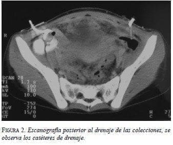 Escanografía Posterior al Drenaje de las Colecciones Escanografía Posterior al Drenaje de las Colecciones