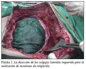 Disección de los Colgajos Laterales Disección de los Colgajos Laterales