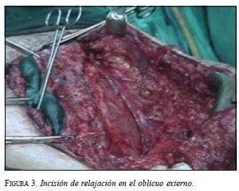 Incisión de Relajación en el Oblicuo Externo Incisión de Relajación en el Oblicuo Externo