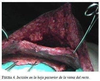 Incisión en la Hoja Posterior de la Vaina del Recto Incisión en la Hoja Posterior de la Vaina del Recto