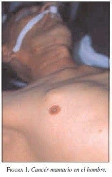 Cancér Mamario en el Hombre