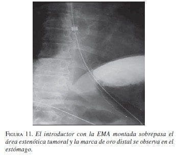 El Introductor con la EMA Montada