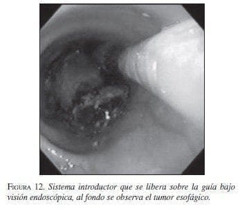 Sistema Introductor que se Libera sobre la Guía bajo Visión Endoscópica