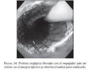 Prótesis Esofágica Liberada con el Empujador aún sin retirar