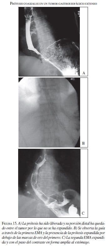 Prótesis Coaxiales en un Tumor Gastroesofágico Extenso