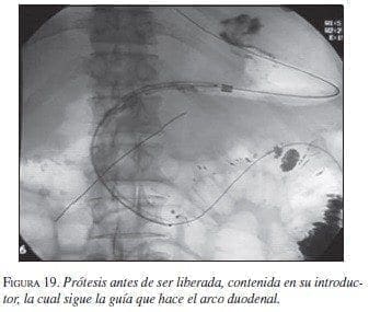 Prótesis antes de ser liberada Prótesis antes de ser liberada