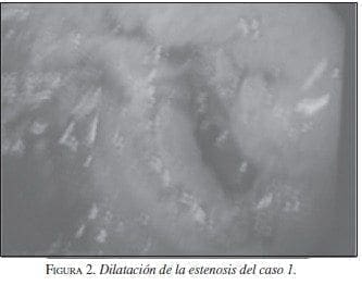 Dilatación de la estenosis del caso 1 Dilatación de la estenosis del caso 1