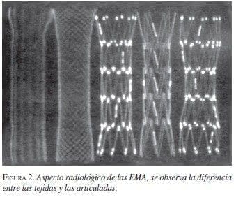 Aspecto radiológico de las EMA Aspecto radiológico de las EMA