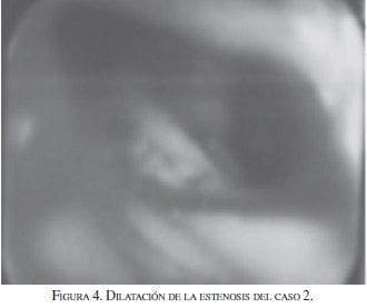 Estenosis del caso 2 Estenosis del caso 2
