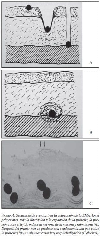 Secuencia de eventos tras la colocación de la EMA Secuencia de eventos tras la colocación de la EMA