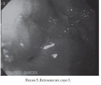 Estenosis del Caso 3 Estenosis del Caso 3