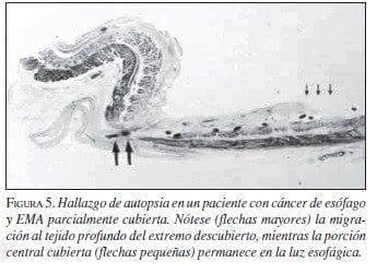 Hallazgo de autopsia en un paciente con cáncer de esófago y EMA Hallazgo de autopsia en un paciente con cáncer de esófago y EMA
