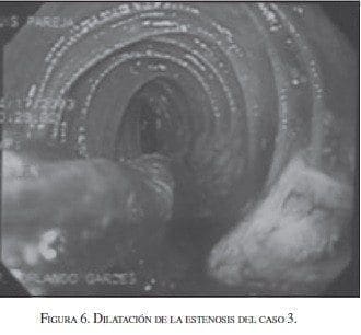 Dilatación de la Estenosis del Caso 3 Dilatación de la Estenosis del Caso 3
