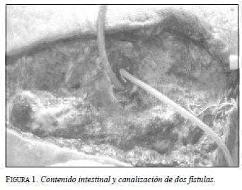 Contenido Intestinal y Canalización de dos Fístulas Contenido Intestinal y Canalización de dos Fístulas