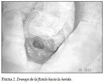Drenaje de la Fístula hacia la Herida Drenaje de la Fístula hacia la Herida