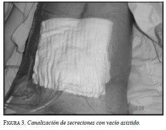 Canalización de Secreciones con Vacío Asistido Canalización de Secreciones con Vacío Asistido
