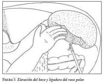 Elevación del Bazo y Ligadura del Vaso Polar Elevación del Bazo y Ligadura del Vaso Polar