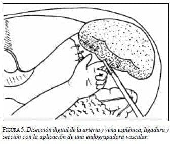 Disección Digital de la Arteria y Vena Esplénica, Ligadura y Sección Disección Digital de la Arteria y Vena Esplénica, Ligadura y Sección