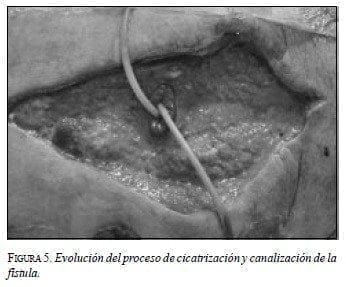 Evolución del Proceso de Cicatrización y Canalización de laFístula Evolución del Proceso de Cicatrización y Canalización de laFístula