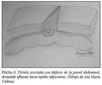 Fístula Asociada con Defecto de la Pared Abdominal Fístula Asociada con Defecto de la Pared Abdominal