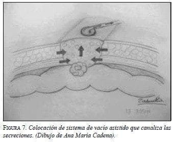 Sistema de Vacío asistido que Canaliza las Secreciones. Sistema de Vacío asistido que Canaliza las Secreciones.