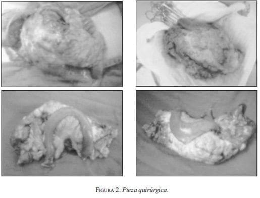 Pieza Quirúrgica Pieza Quirúrgica