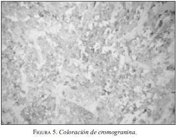 Coloración de cromogranina Coloración de cromogranina