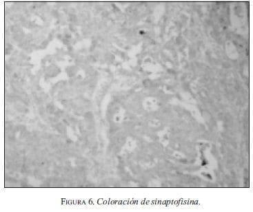 Coloración de sinaptofisina. Coloración de sinaptofisina.