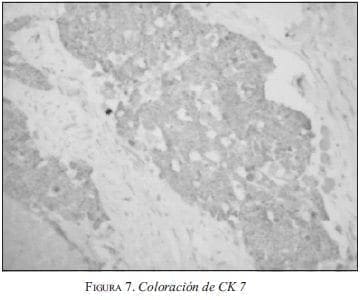 Coloración de CK 7 Coloración de CK 7