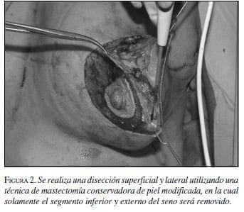 Disección Superficial y Lateral utilizando una Técnica de Mastectomía