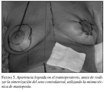 Apariencia lograda en el transoperatorio