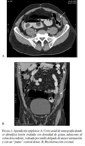 Apendicitis Epiploica, Corte axial y Reconstrucción coronal